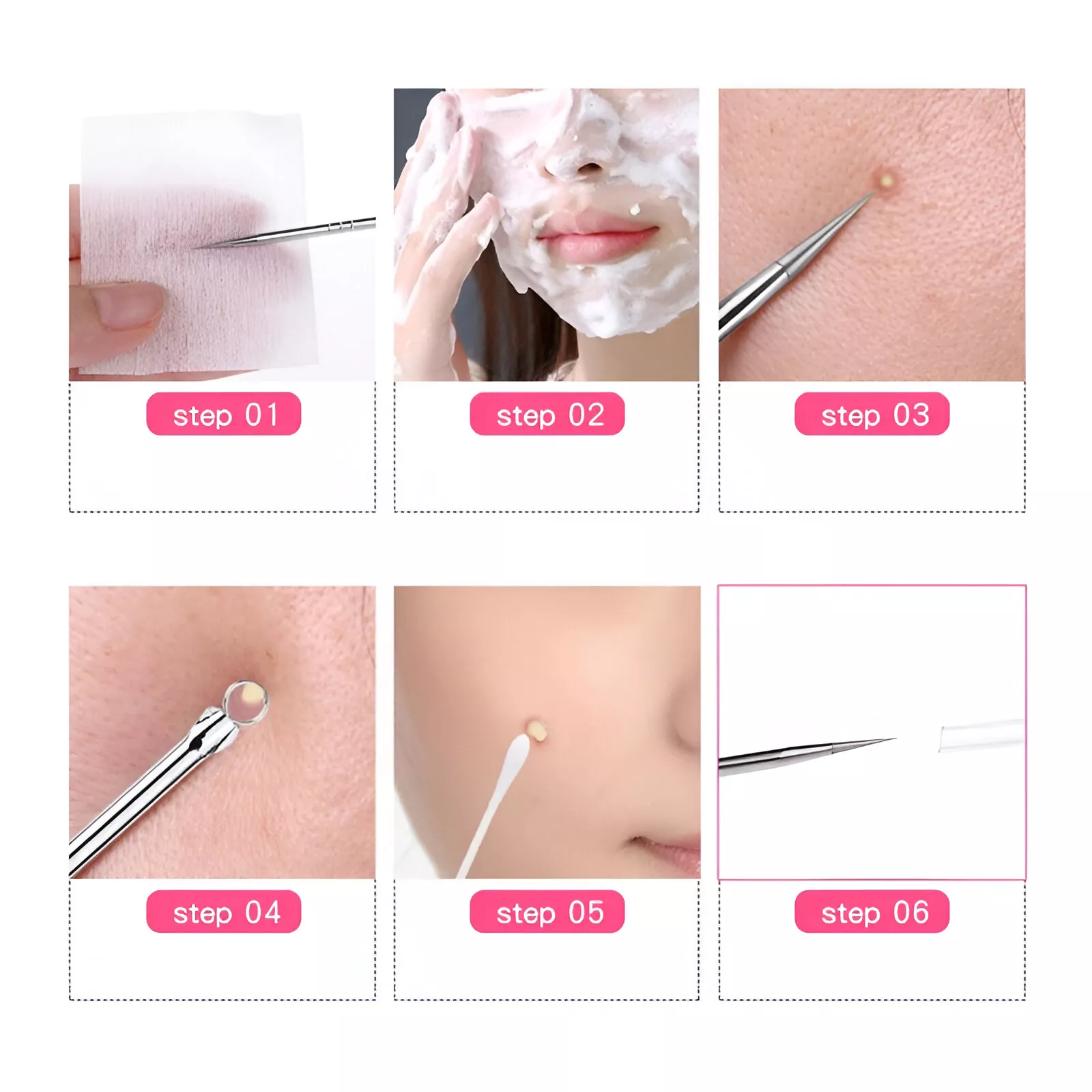 Blackhead & Acne Extractor Tool - Image 5